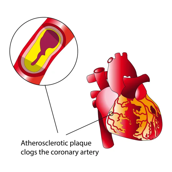 Atherosclerotic plaque — Stock Vector