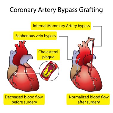 Coronary Artery Bypass clipart