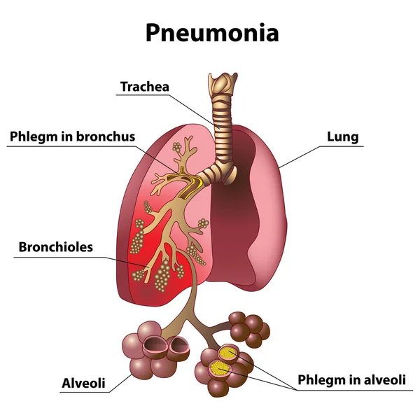 Pneumonia — Vetor de Stock