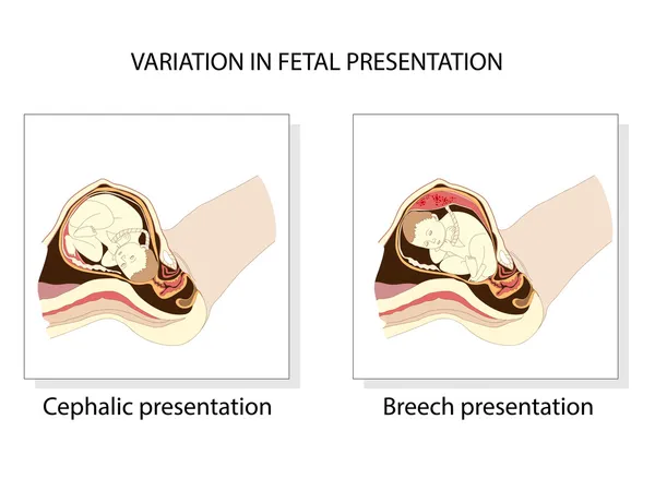 Variação na apresentação fetal — Vetor de Stock