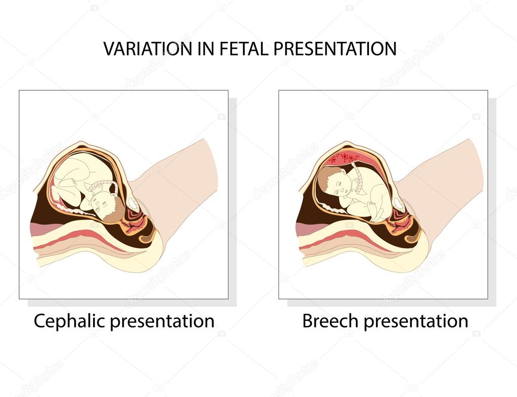 Variation in fetal presentation Stock Vector Image by ©Maryna_Melnyk  #38852535