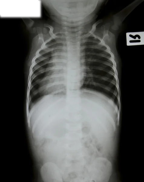 Zdjęcie rentgenowskie młody chłopak. — Zdjęcie stockowe
