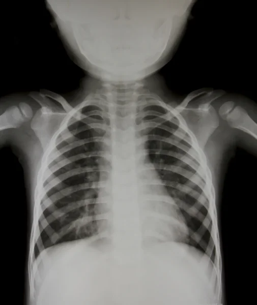 Chest x-ray of young boy. — Stock Photo, Image