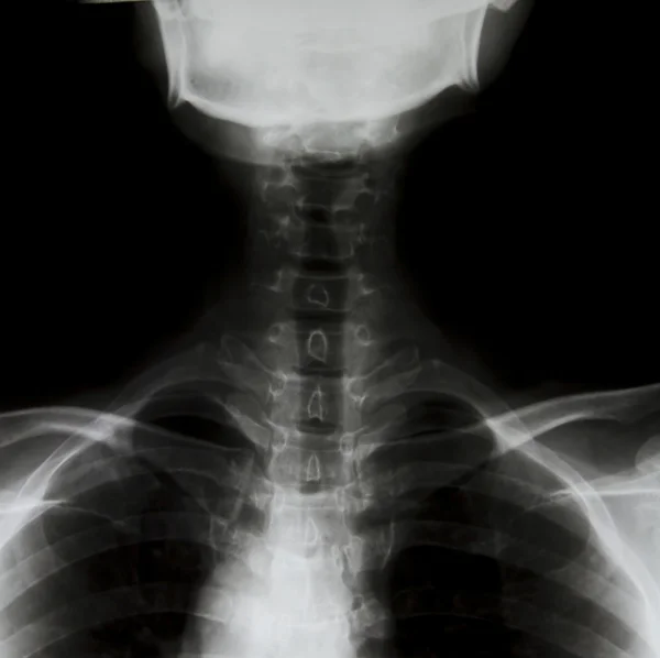 脖子上的 x 射线图像的详细信息. — 图库照片