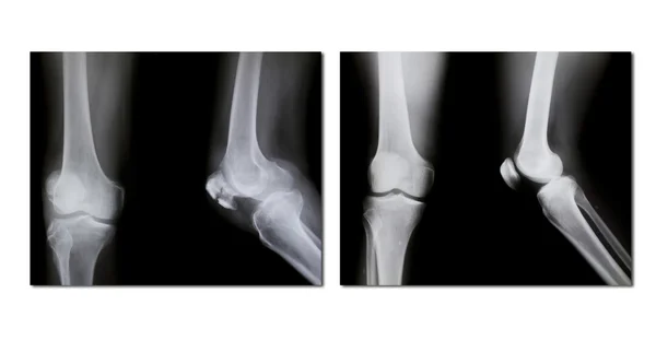 Collectie van x-ray (gebroken knie, normale knie) — Stockfoto