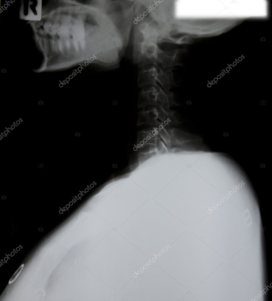 Detalle de la imagen de rayos X del cuello. 2022