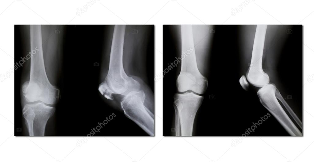 collection of x-ray (broken knee, normal knee)