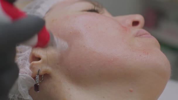 Närbild av en kvinnas ansikte. Nål mesotherapy förfarande i huden i ansiktet — Stockvideo