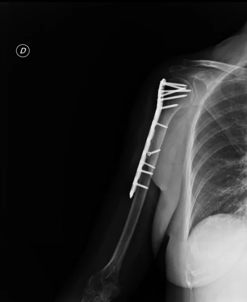 Broken shoulder — Stock Photo, Image