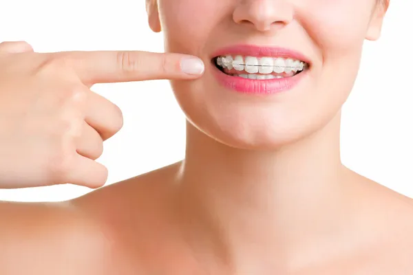 Braces — Stock Photo, Image