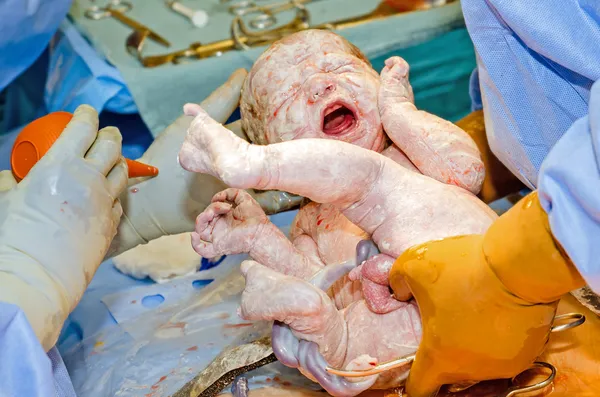 Säugling wird im Krankenhaus per C-Schnitt entbunden — Stockfoto