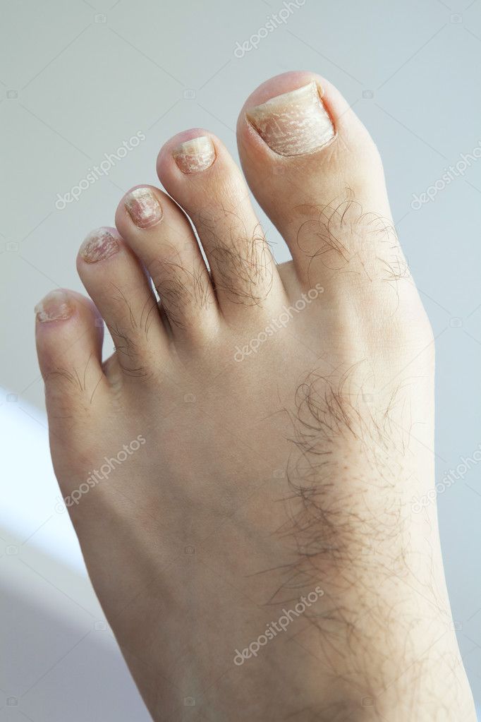 gomba betegségek nail foot)