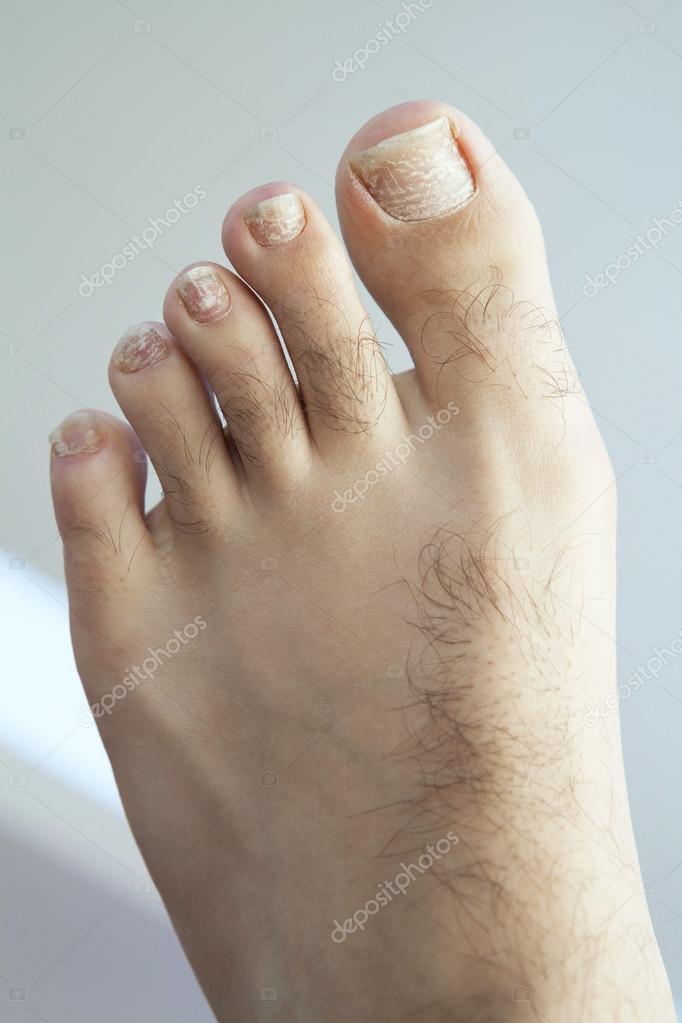 gomba betegségek nail foot