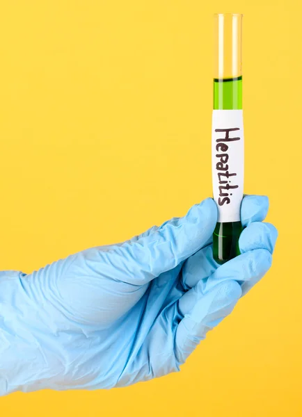 Test tube labeled Hepatitis in hand on yellow background — Stock Photo, Image