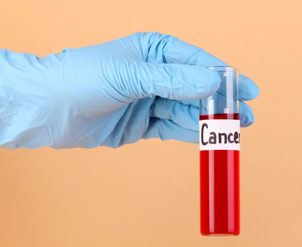 Test tube labeled Cancer in hand on beige background — Stock Photo, Image