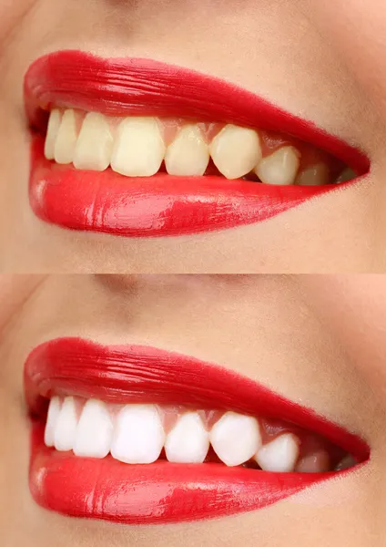 Mulheres sorriem com dentes: clareamento - tratamento clareador, antes e depois — Fotografia de Stock