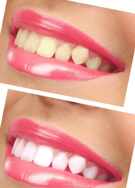 Frauen lächeln mit Zähnen: Bleaching - Bleichbehandlung, vor und nach der Behandlung — Stockfoto
