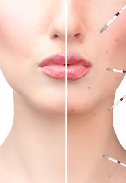 Жіноче обличчя до і після ін'єкцій акне і збільшення губ ізольовано на білому — стокове фото