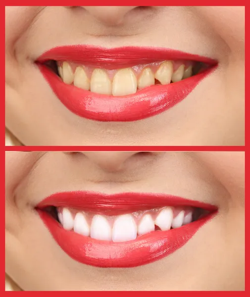 Le donne sorridono con i denti: sbiancamento - trattamento di sbiancamento, prima e dopo — Foto Stock