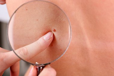 hastanın bir doğum lekesi dermatolog inceler, yakın çekim