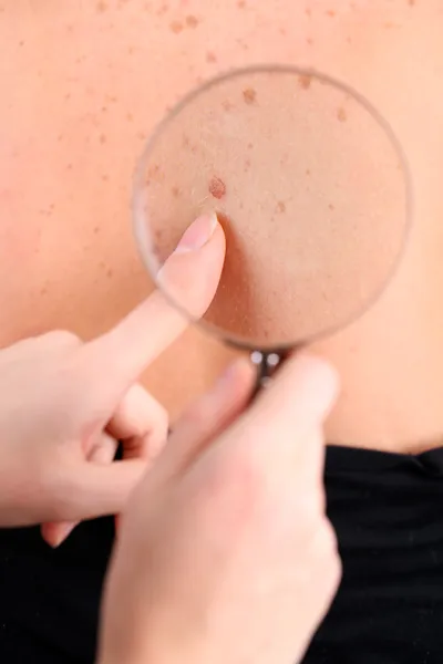 Dermatoloog onderzoekt een moedervlek van patiënt, close-up — Stockfoto