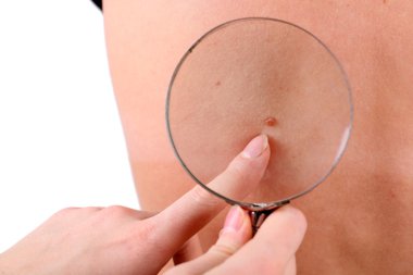 Dermatologist examines a birthmark of patient, close up clipart