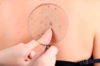 hastanın bir doğum lekesi dermatolog inceler, yakın çekim