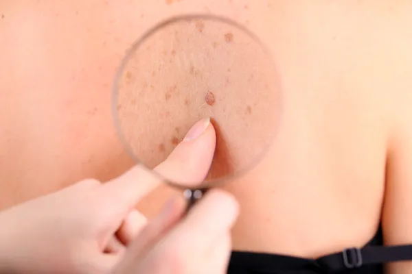 Dermatologista examina uma marca de nascença do paciente, de perto — Fotografia de Stock