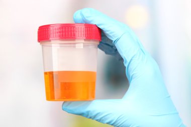 Medical urine test, close-up clipart