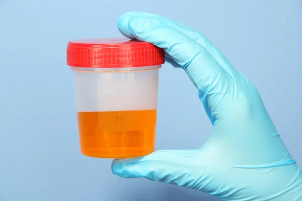 Medical urine test, close-up — Stock Photo, Image