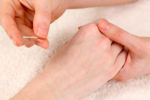 Acupuntura en la mano, de cerca. Aislado sobre blanco — Foto de Stock