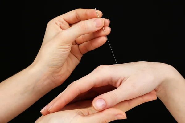 Akupunktur zur Hand, Nahaufnahme, auf dunklem Hintergrund — Stockfoto
