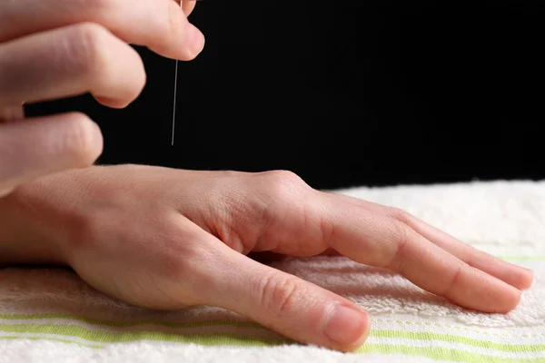 Acupuncture on hand, close up, on dark background — Stock Photo, Image