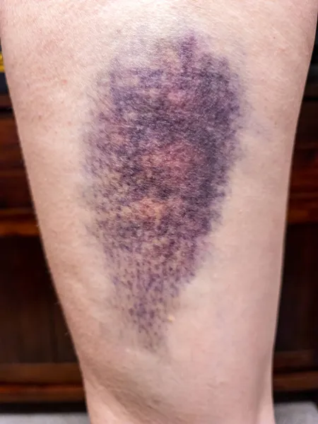 Grandes nódoas negras coloridas na perna superior. Hematoma — Fotografia de Stock