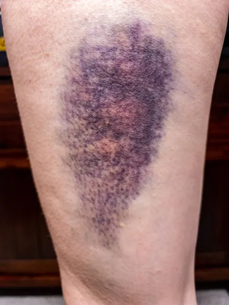 Daño grande por moretones de color en la parte superior de la pierna. Hematoma — Foto de Stock