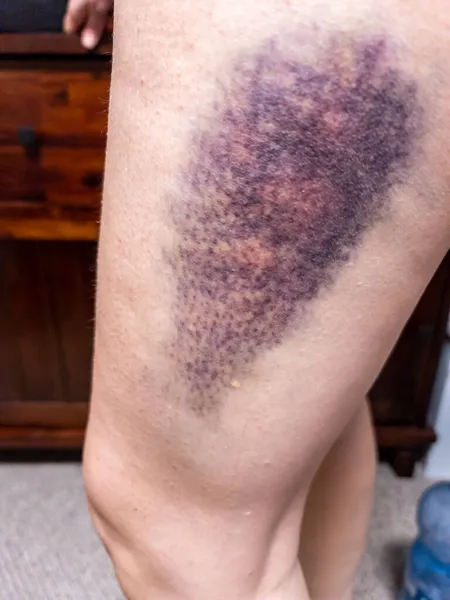 Grandes nódoas negras coloridas na perna superior. Hematoma — Fotografia de Stock