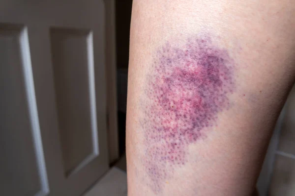 Hematomas terríveis na perna superior de uma mulher — Fotografia de Stock
