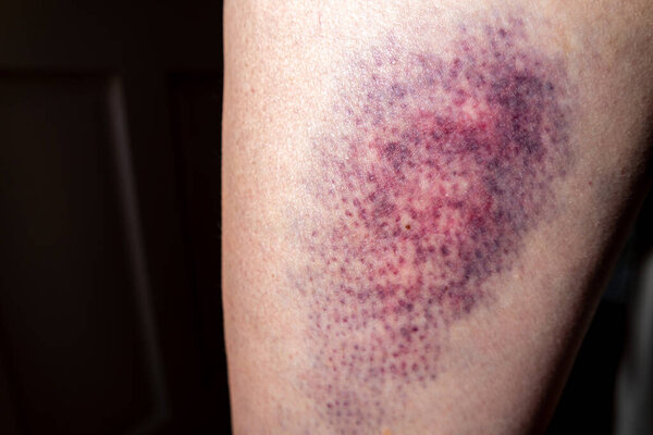 Terrible bruise on the upper leg of a woman