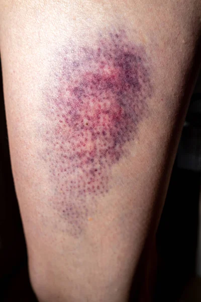 Hematomas terríveis na perna superior de uma mulher — Fotografia de Stock