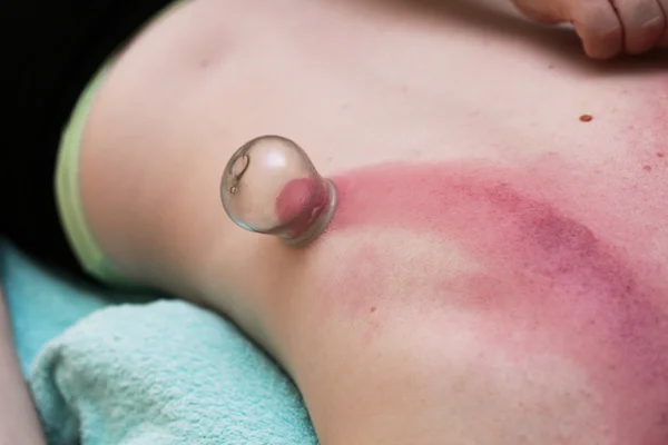 Fire cupping treatment to cup sb therapy woman — Stock Photo, Image