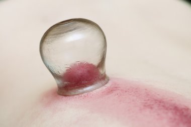 Yangın çukurluğu tedaviye Kupası sb tedavi kadın