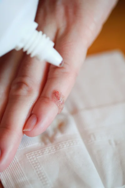 Disinfect the scratch by rubbing in alcohol — Stock Photo, Image