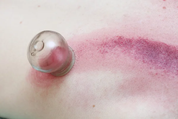 Fire cupping treatment to cup sb therapy woman — Stock Photo, Image