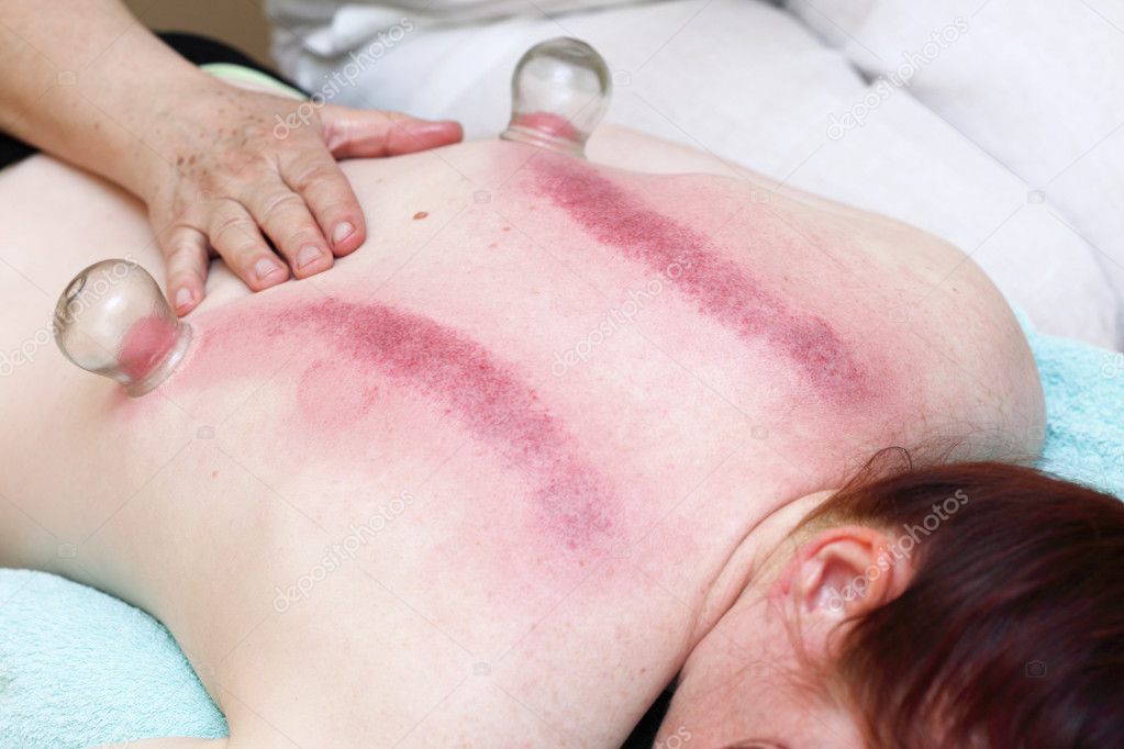 fire cupping treatment to cup sb therapy woman