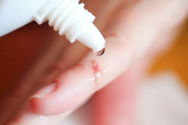 Disinfect the scratch by rubbing in alcohol Stock Photo