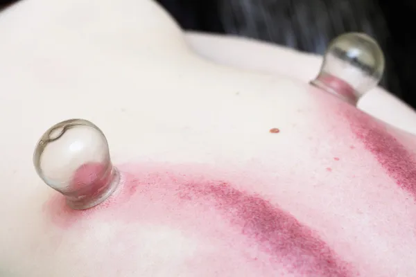 Fire cupping treatment to cup sb therapy woman — Stock Photo, Image