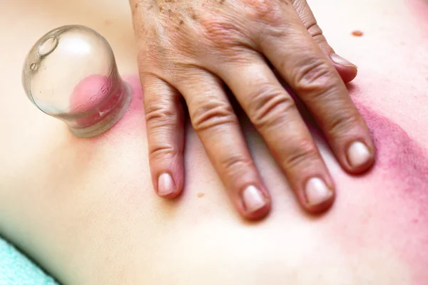 Fire cupping treatment to cup sb therapy woman — Stock Photo, Image