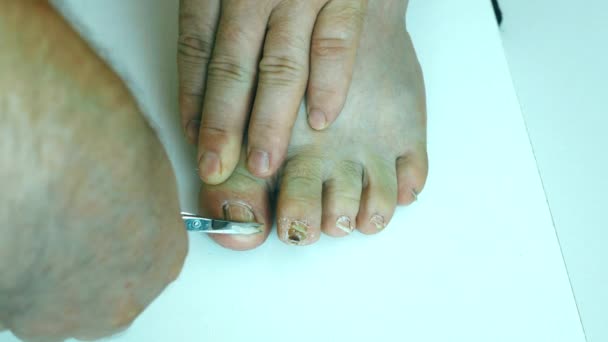 男人用剪刀剪下厚重的脚趾甲 男人在脚上修脚 脚趾上的真菌 脚上的感染脚趾甲护理 皮肤上的皮肤病四 后续行动 — 图库视频影像