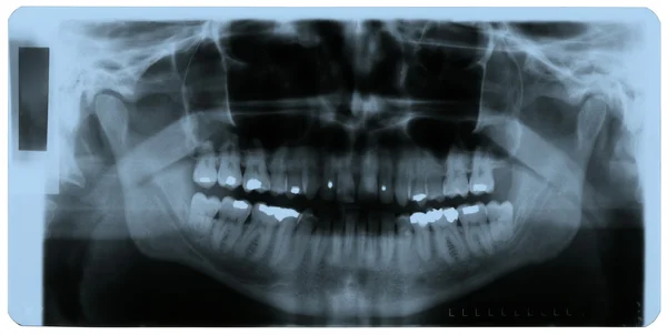 X-ray foto van menselijke tanden — Stockfoto