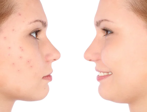 Clear skin concept with portrait of young girl — Stock Photo, Image